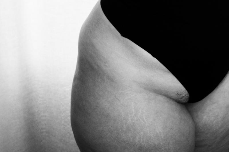 Ein Ausschnitt einer Frau in schwarzer Unterhose von Bauch bis Oberschenkel mit sichtbarem Lipödem. Das Bild ist schwarzweiß.